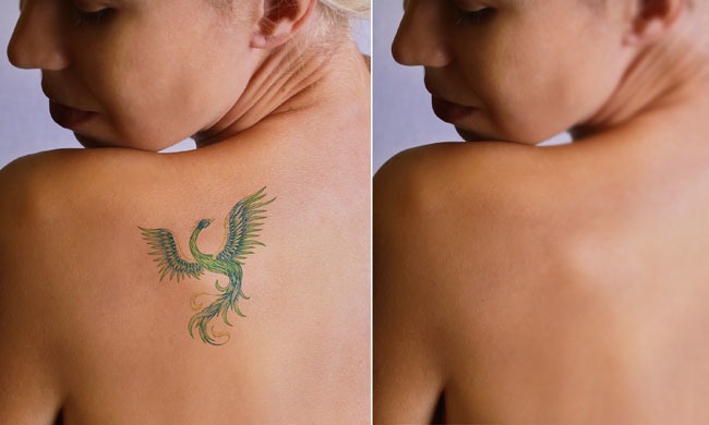 Pre & Post Tattoo Removal | Tattoo Removal Institute