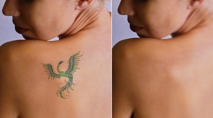 The laserless tattoo removal guide review – cheap & effective