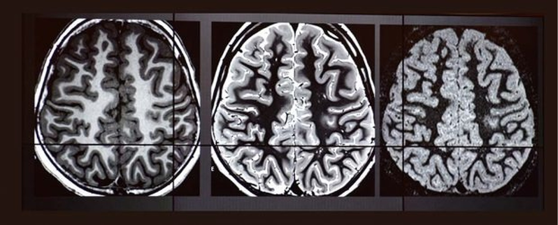 Resonancia magnética estructural en la epilepsia